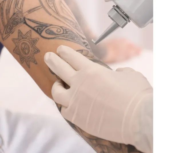 Remoção de tatuagem a lesar  micropigmentação - 99, a sessão. - Foto 2