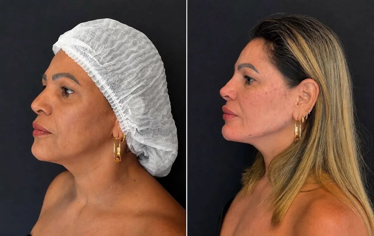 Paciente modelo- Full face preenchimentos ácido hialurônico  - Foto 3
