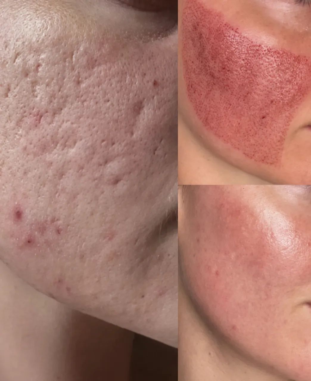 Modelo para cicatrizes de acne ? R$ 150 por sessão