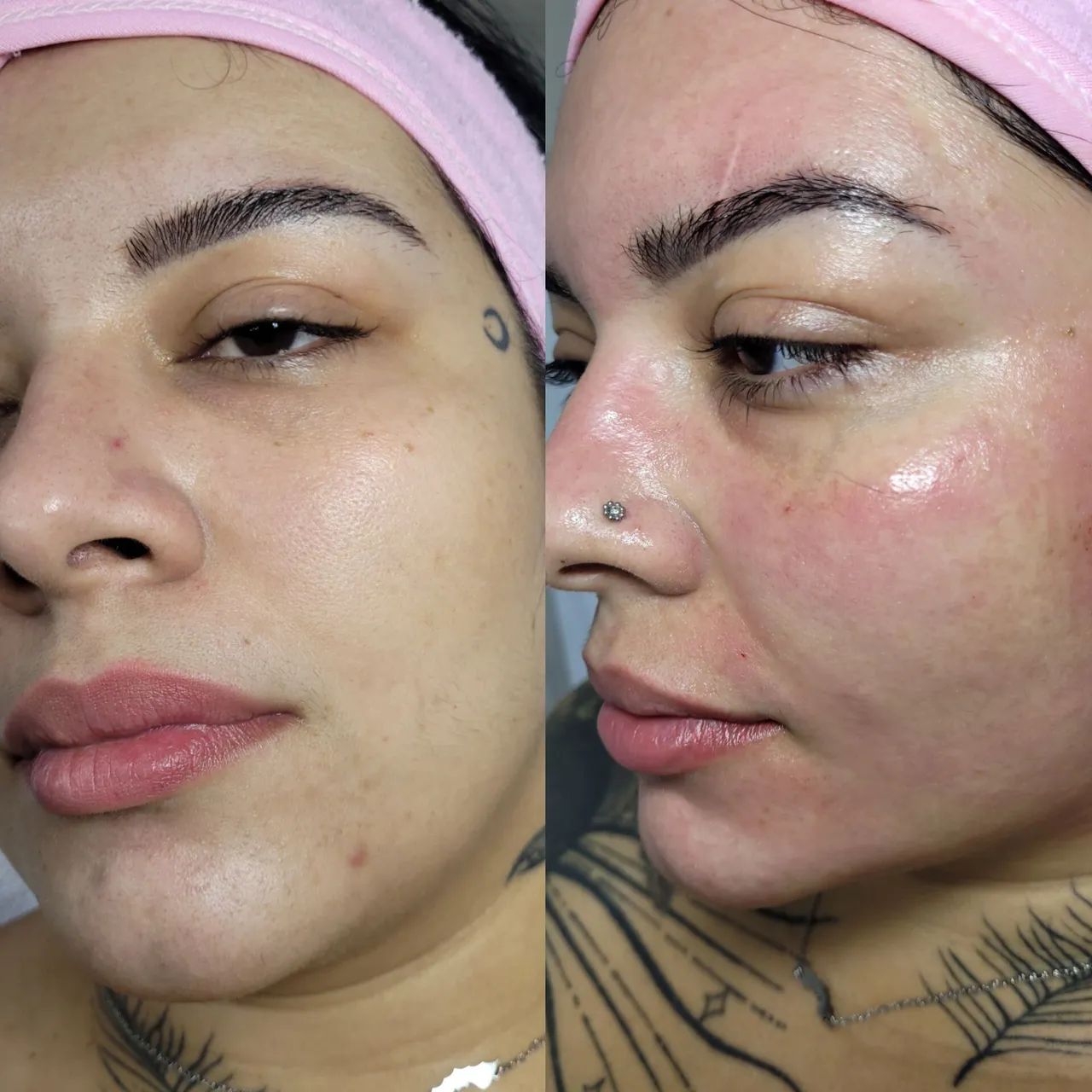 Microagulhamento  - Foto 3