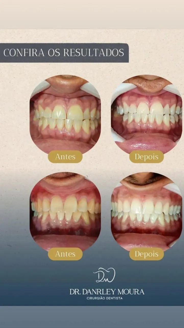 Clareamento dental  - Foto 2