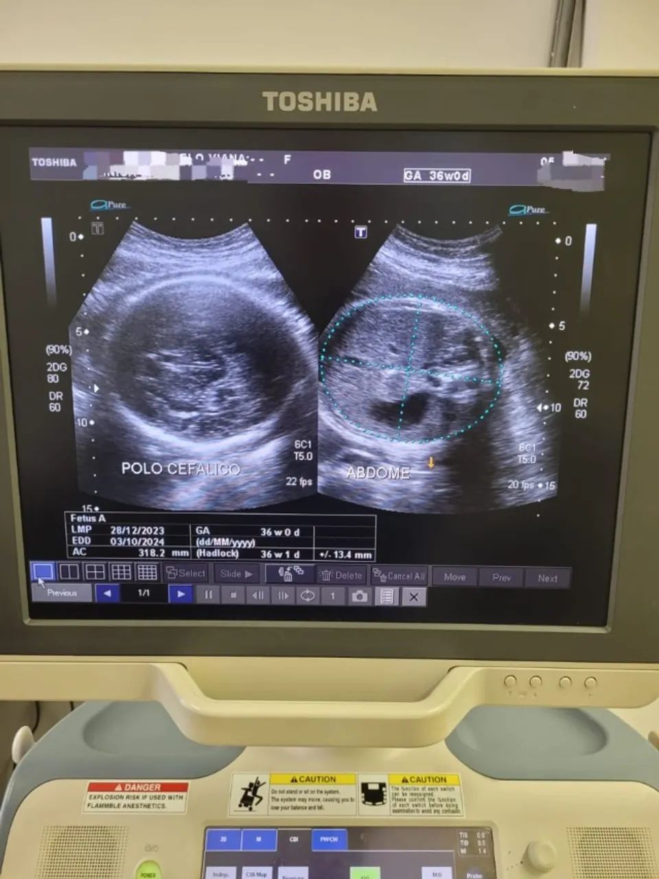 Aparelho de Ultrassom Toshiba Xario XG - Foto 4