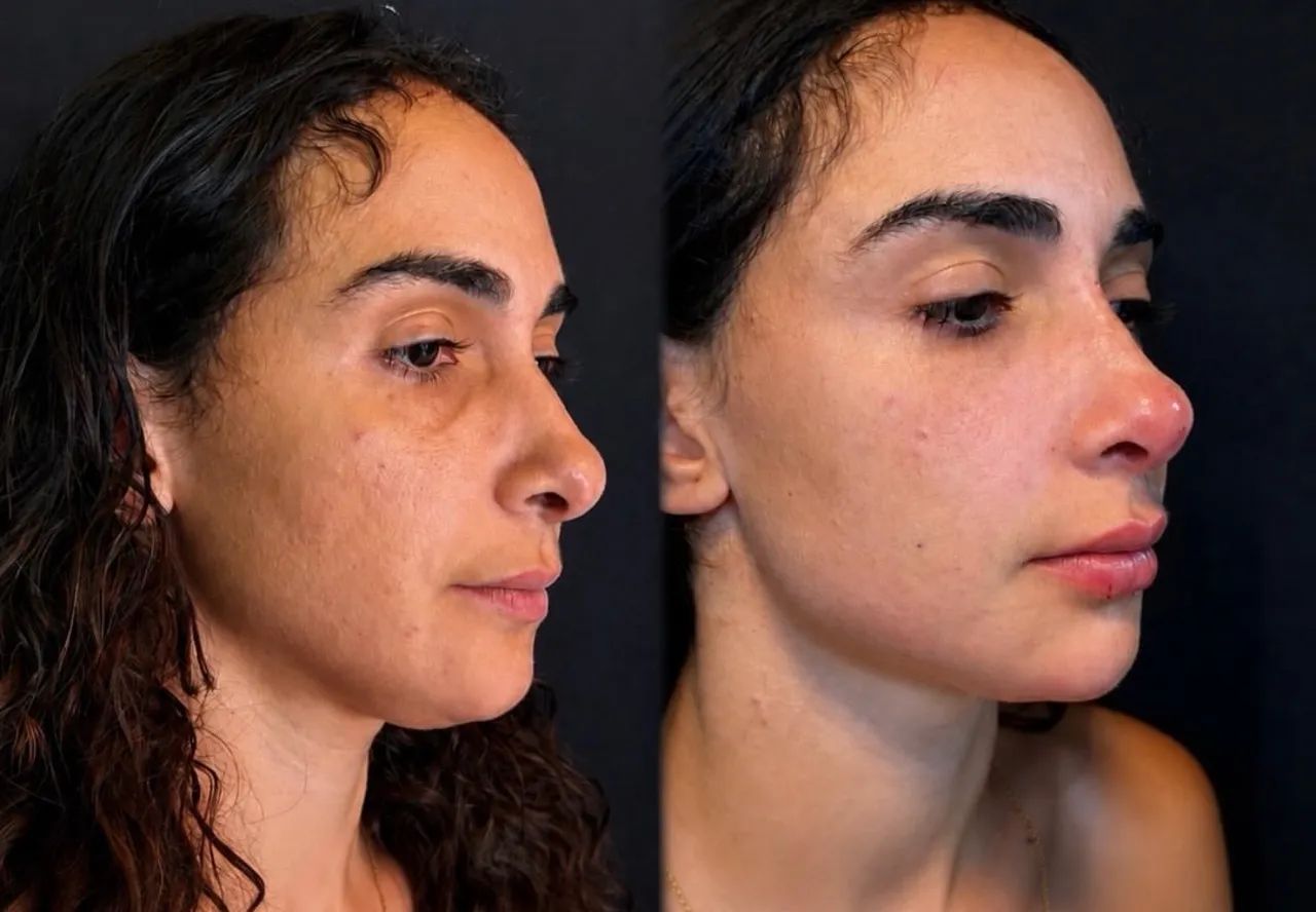 Paciente modelo- Full face preenchimentos ácido hialurônico  - Foto 4