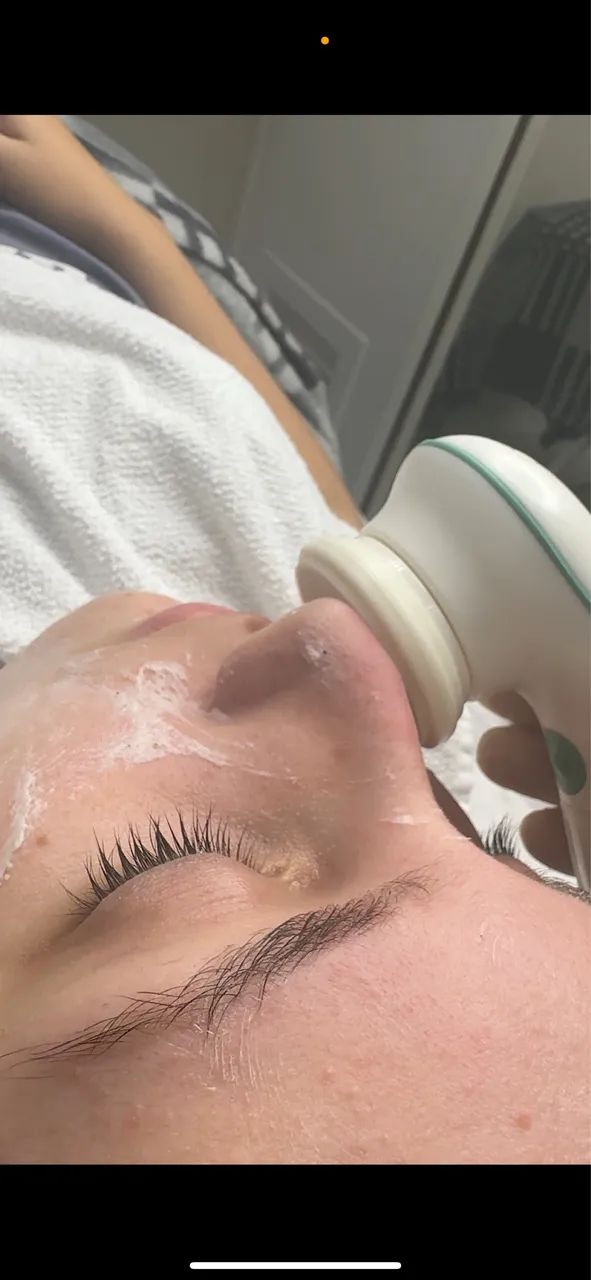 Limpeza Facial - Foto 2