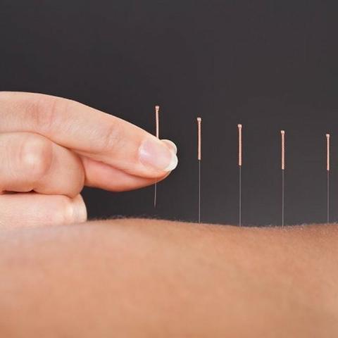 Acupuntura em Domicílio