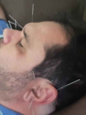 Acupuntura em Domicílio - Foto 4