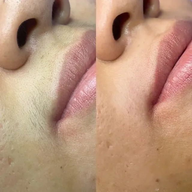 DEPILAÇÃO/LIMPEZA DE PELE - Foto 2