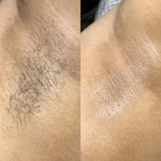 DEPILAÇÃO/LIMPEZA DE PELE - Foto 3