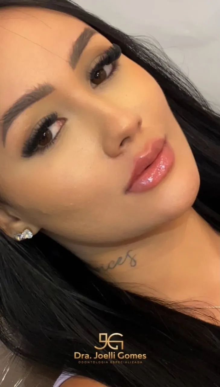 Preenchimento labial 