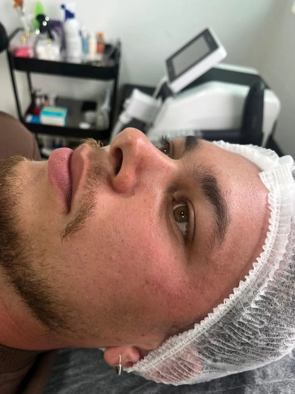 Limpeza de pele com extração de Cravos  - Foto 2