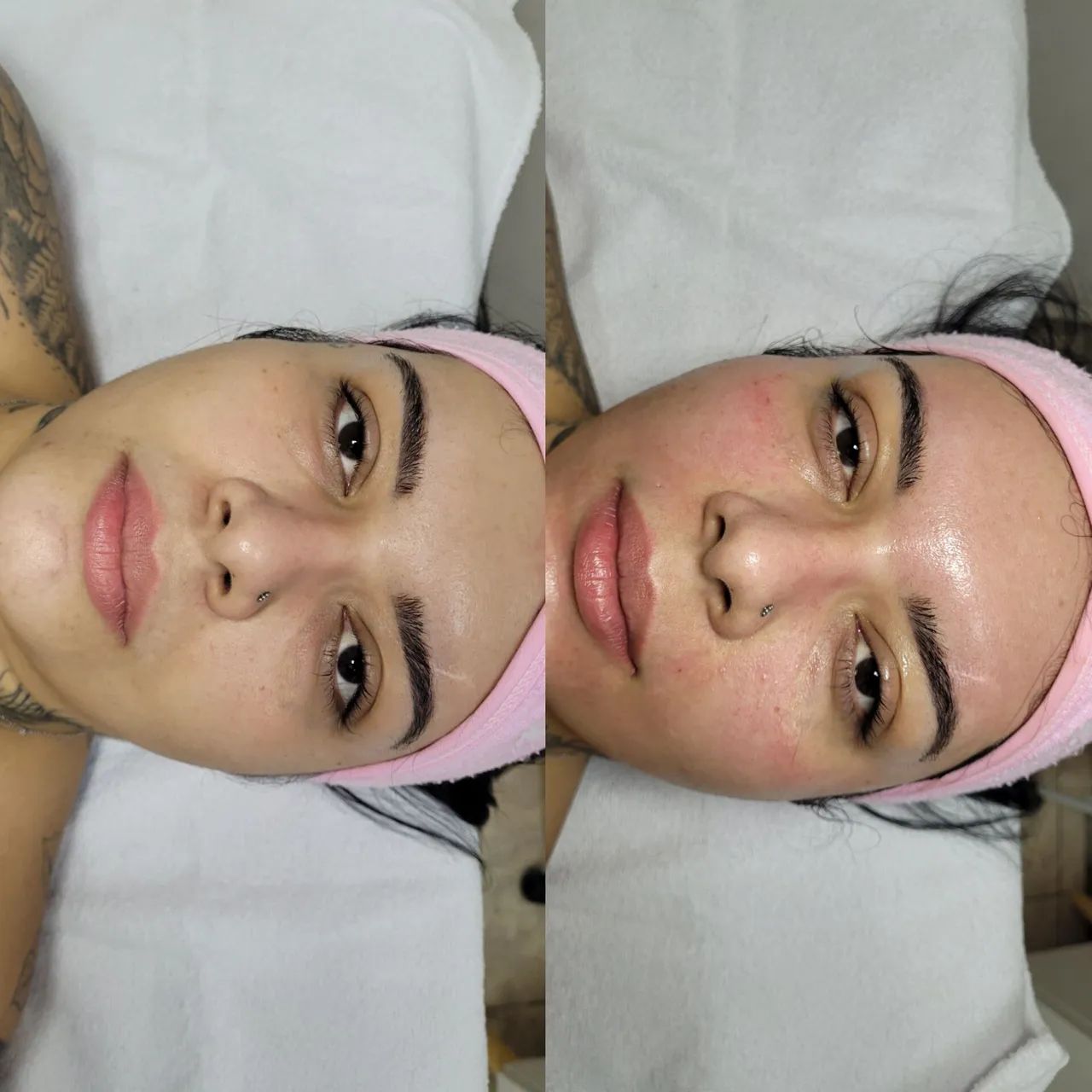 Microagulhamento  - Foto 5