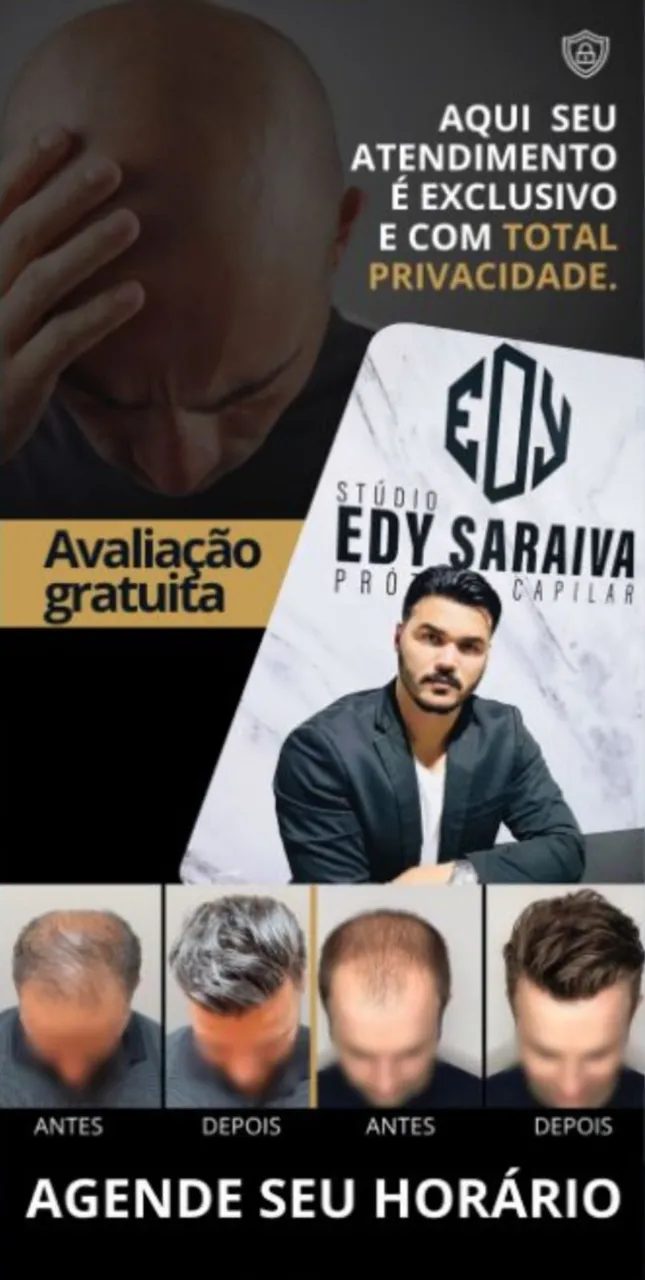 Acaba com a Calvice! Prótese Capilar Natural - Varzea Grande