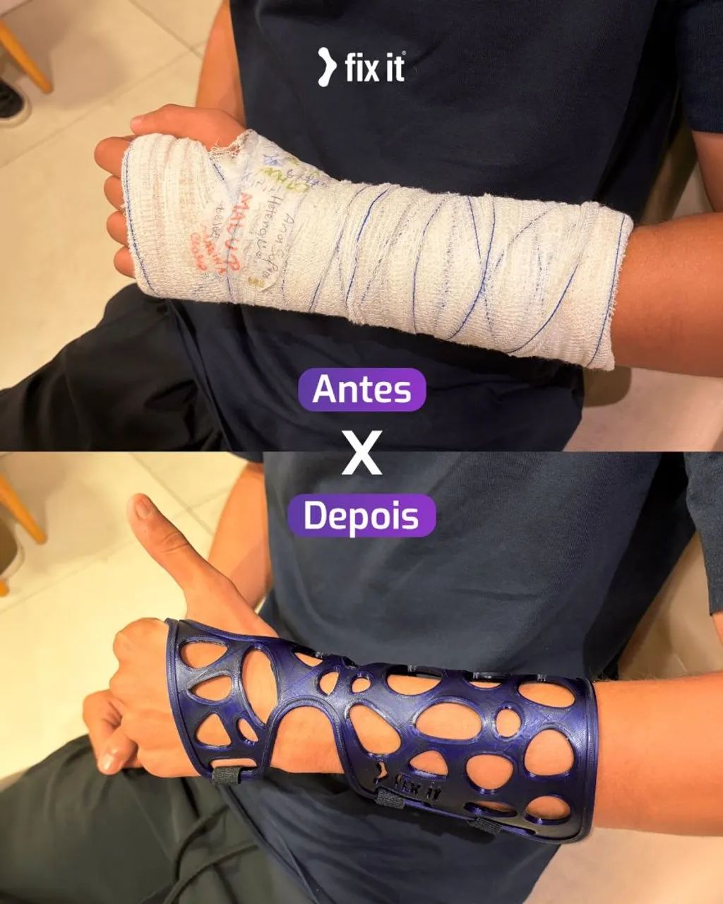 Órteses 3D  - Foto 2