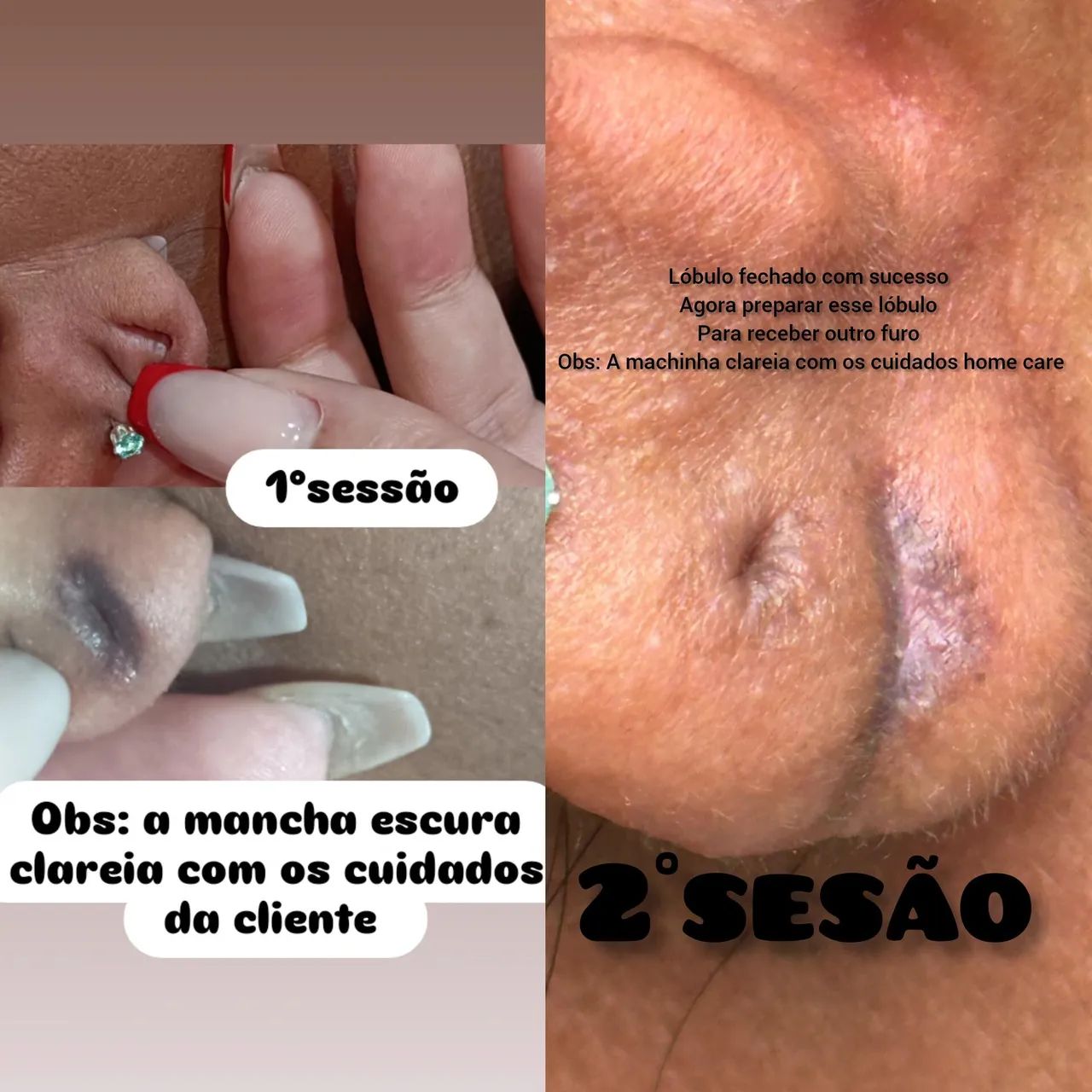 Lobulomodelação  - Foto 3
