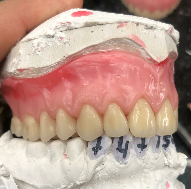 Ponte móvel ,dentadura ,ponte com grampo e protese de silicone ,a partir de 400 - Foto 2