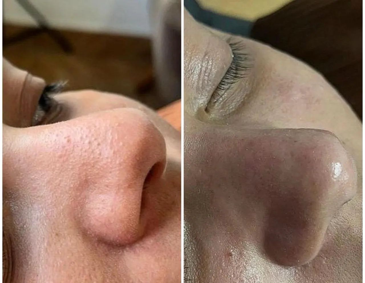 Limpeza de pele com extração de Cravos  - Foto 4