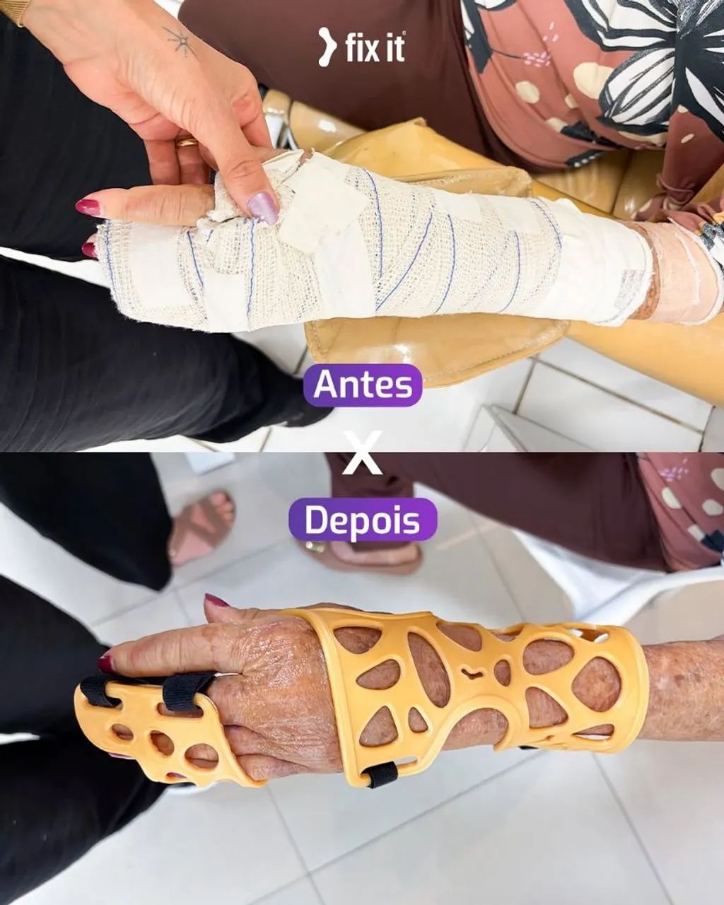 Órteses 3D  - Foto 3