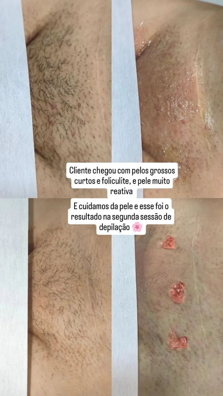 Depilação personalizada 
