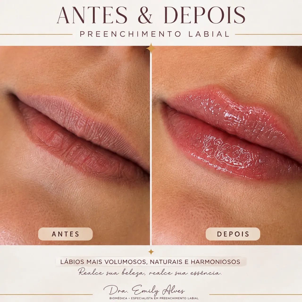 PREENCHIMENTO LABIAL 