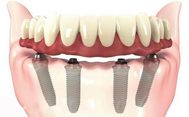 Implantes e prótese sobre implante