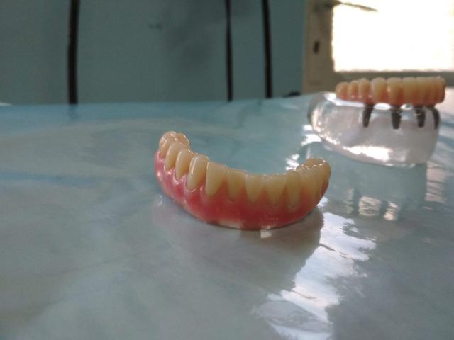 Implantes e prótese sobre implante - Foto 3