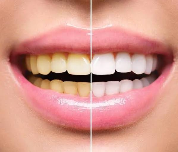 Clareamento dentes