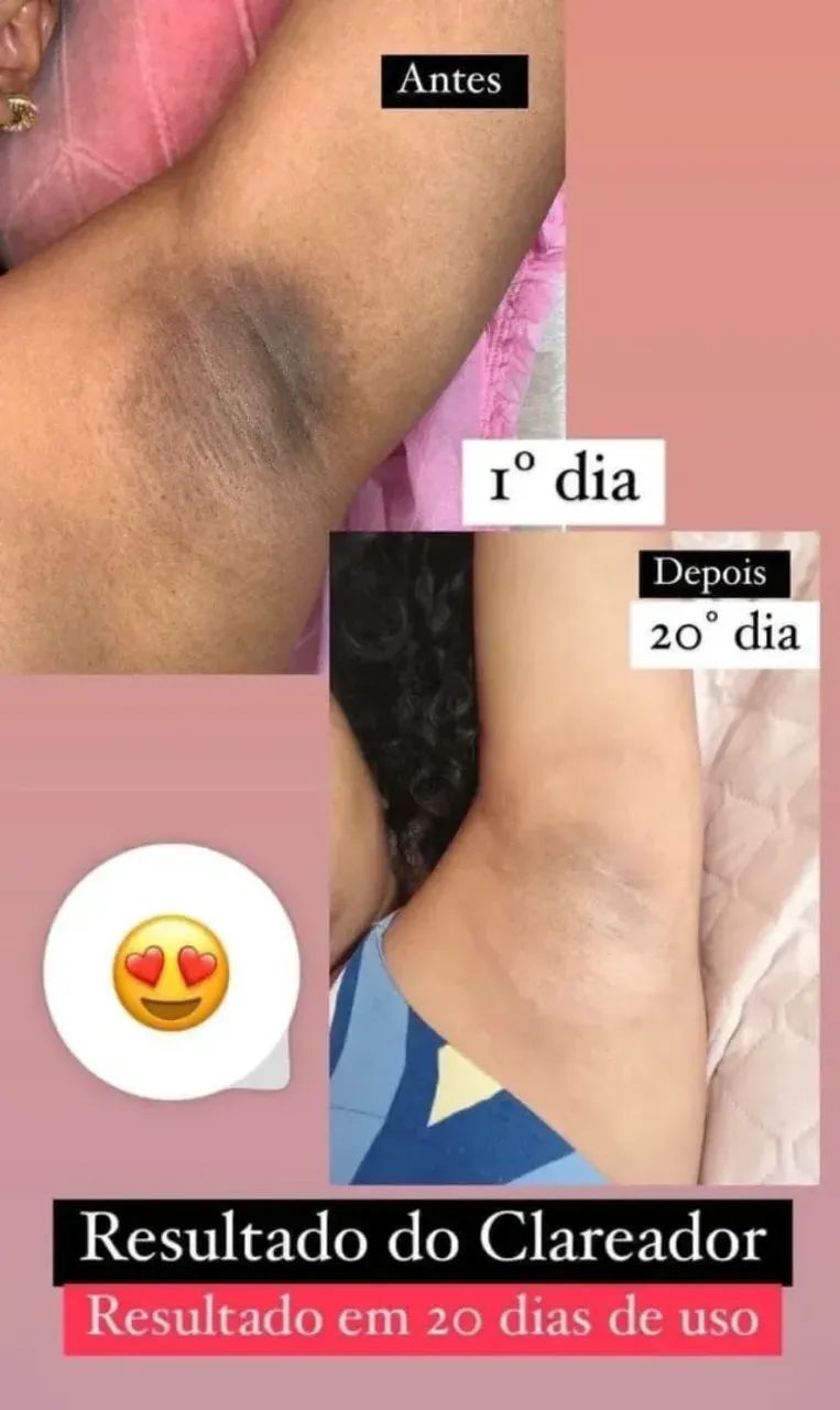 Clareador de Manchas de pele - Pague somente na entrega - Foto 6