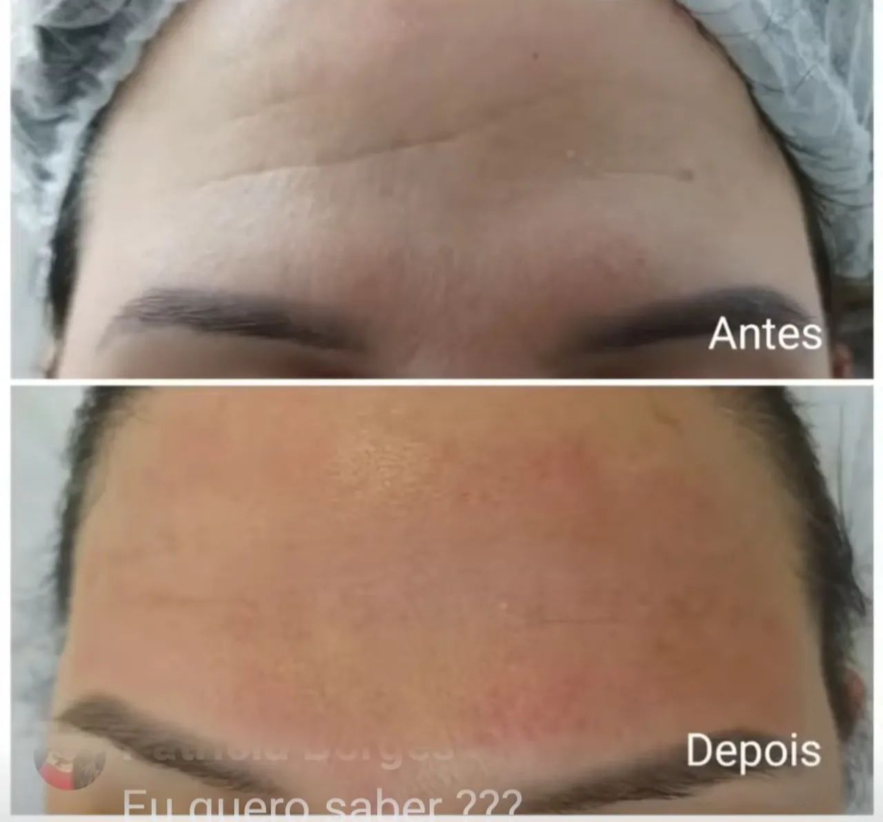 PREENCHIMENTO COM ÁCIDO HIALURÔNICO EM PÓ  - Foto 3