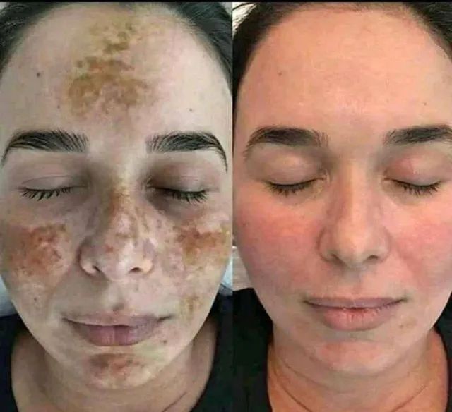 Clareador de Manchas de pele - Pague somente na entrega - Foto 4