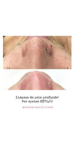 Limpeza de Pele Profunda