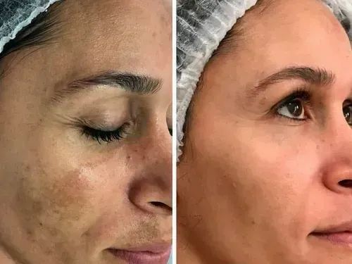 Clareador de Manchas de pele - Pague somente na entrega - Foto 3