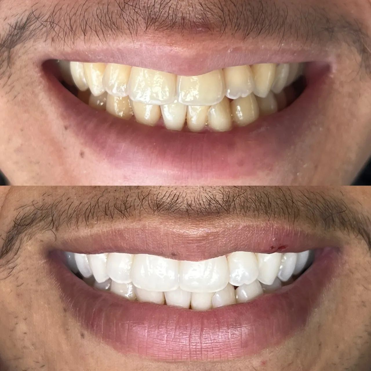 Clareamento dental 