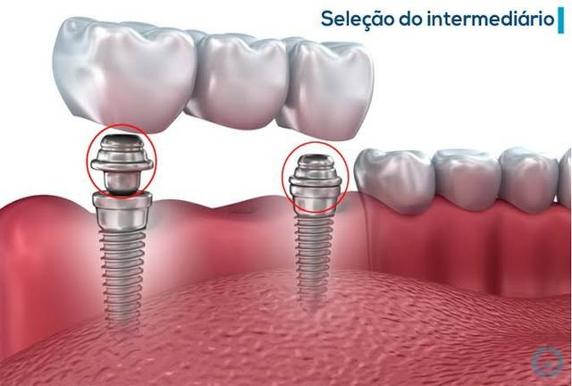 Implantes e prótese sobre implante - Foto 2