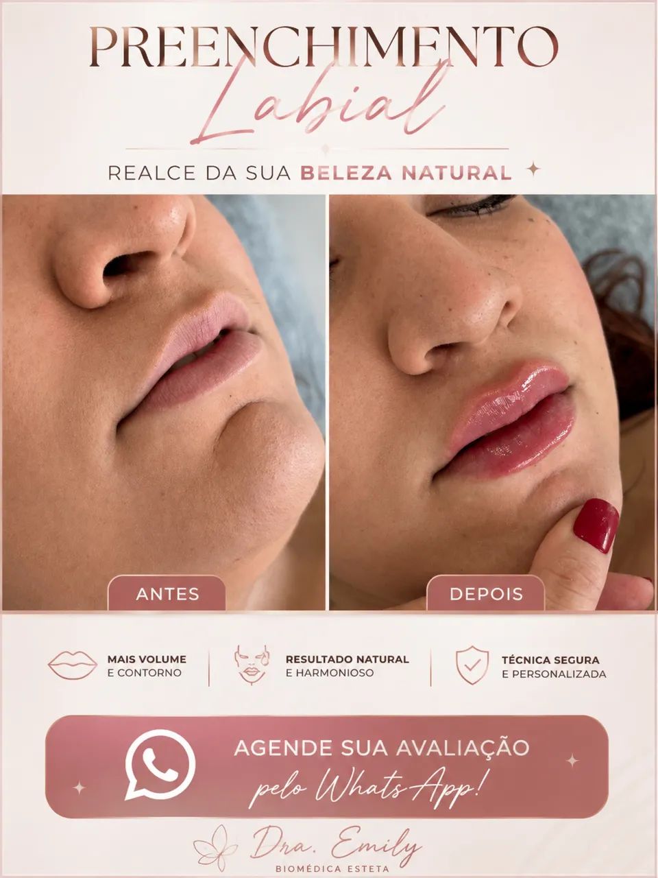 PREENCHIMENTO LABIAL  - Foto 3