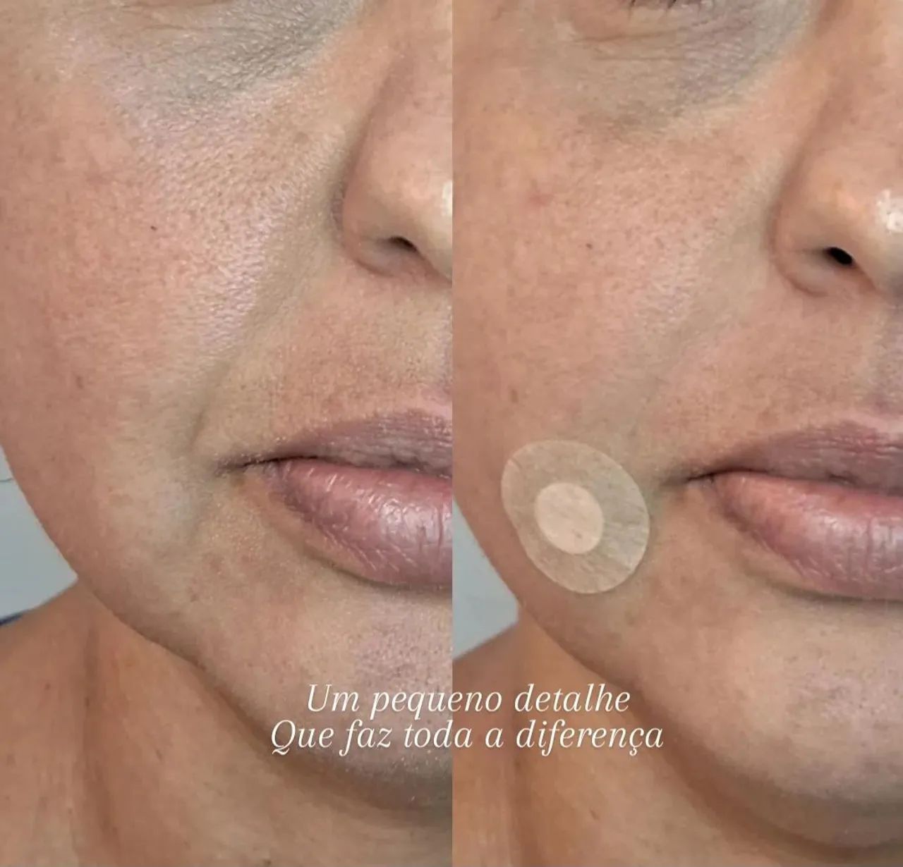 Preenchimentos Faciais, corporais e íntimo