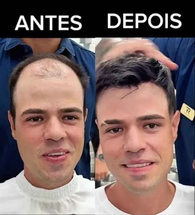 protese capilar - Foto 4