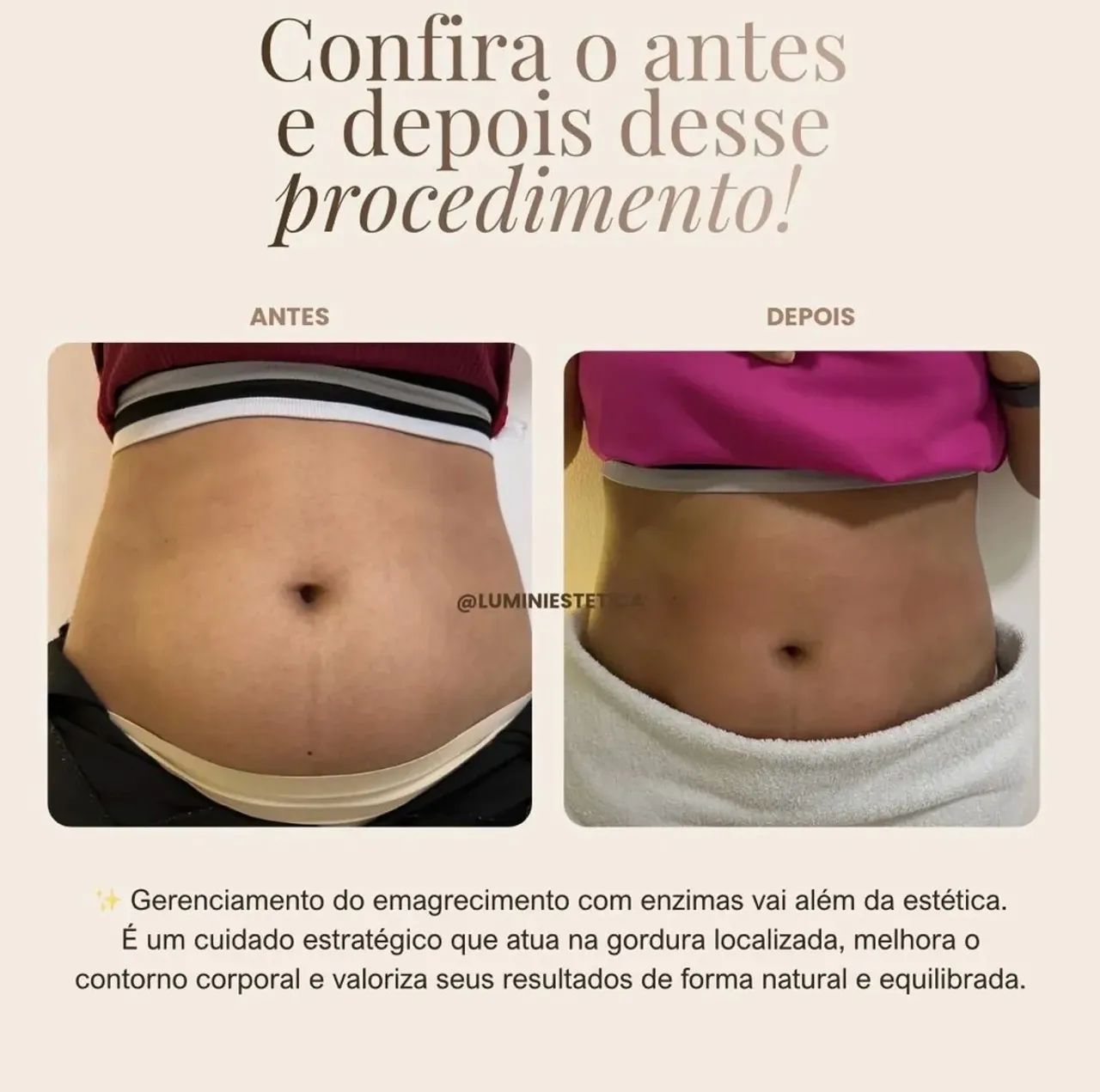 Protocolo de redução de gordura localizada  - Foto 4