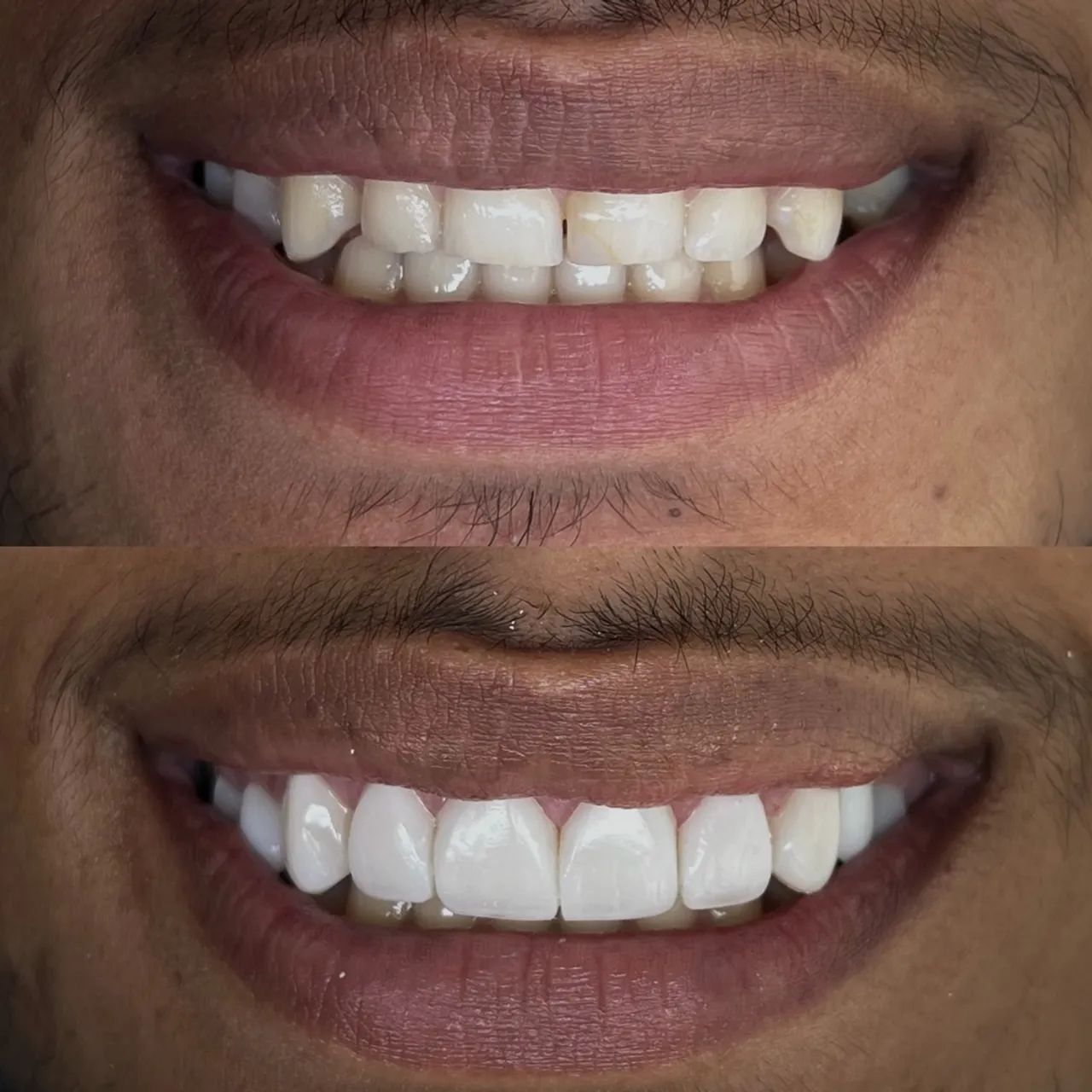 Faceta dentária 