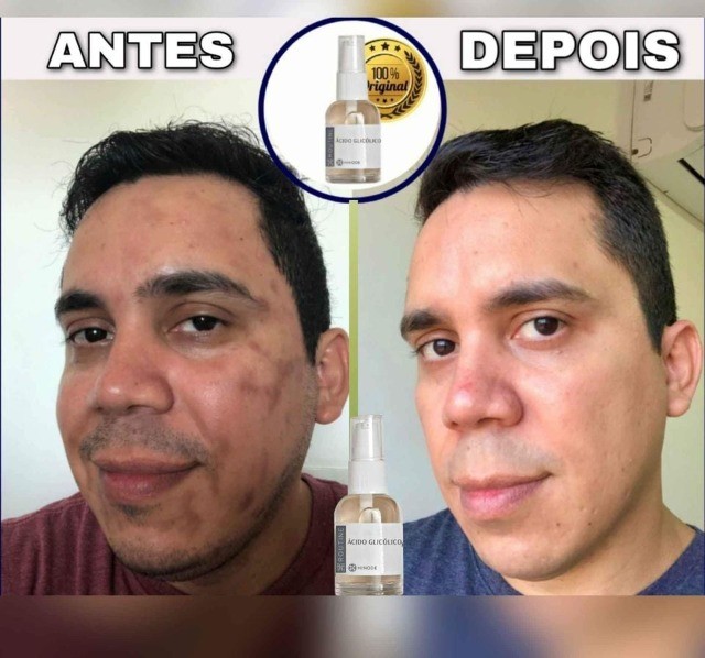 Clareador de Machas Ácido Glicólico