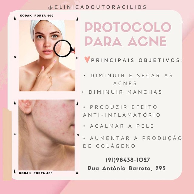 Protocolo para Acne