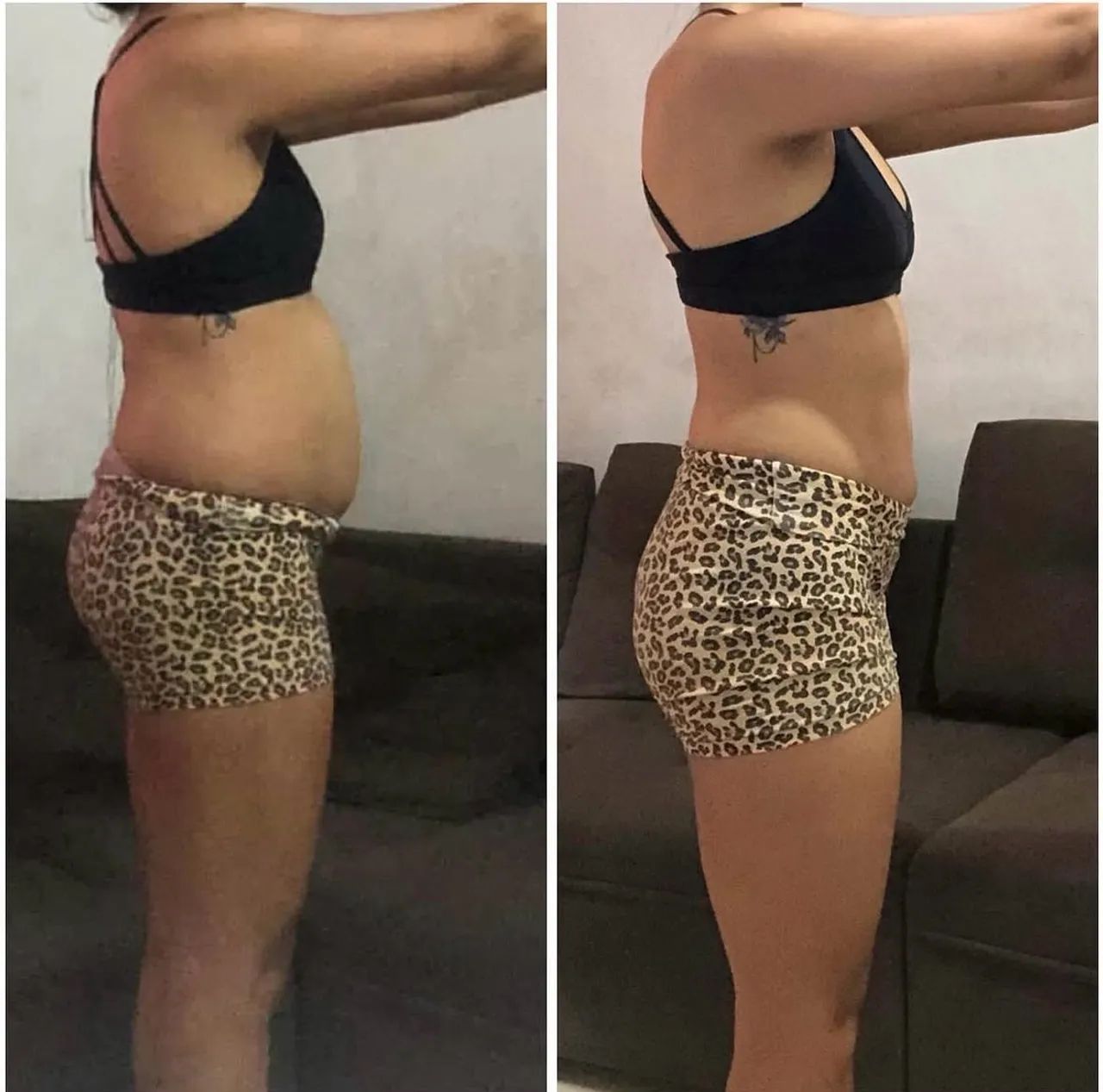 Protocolo de redução de gordura localizada  - Foto 5