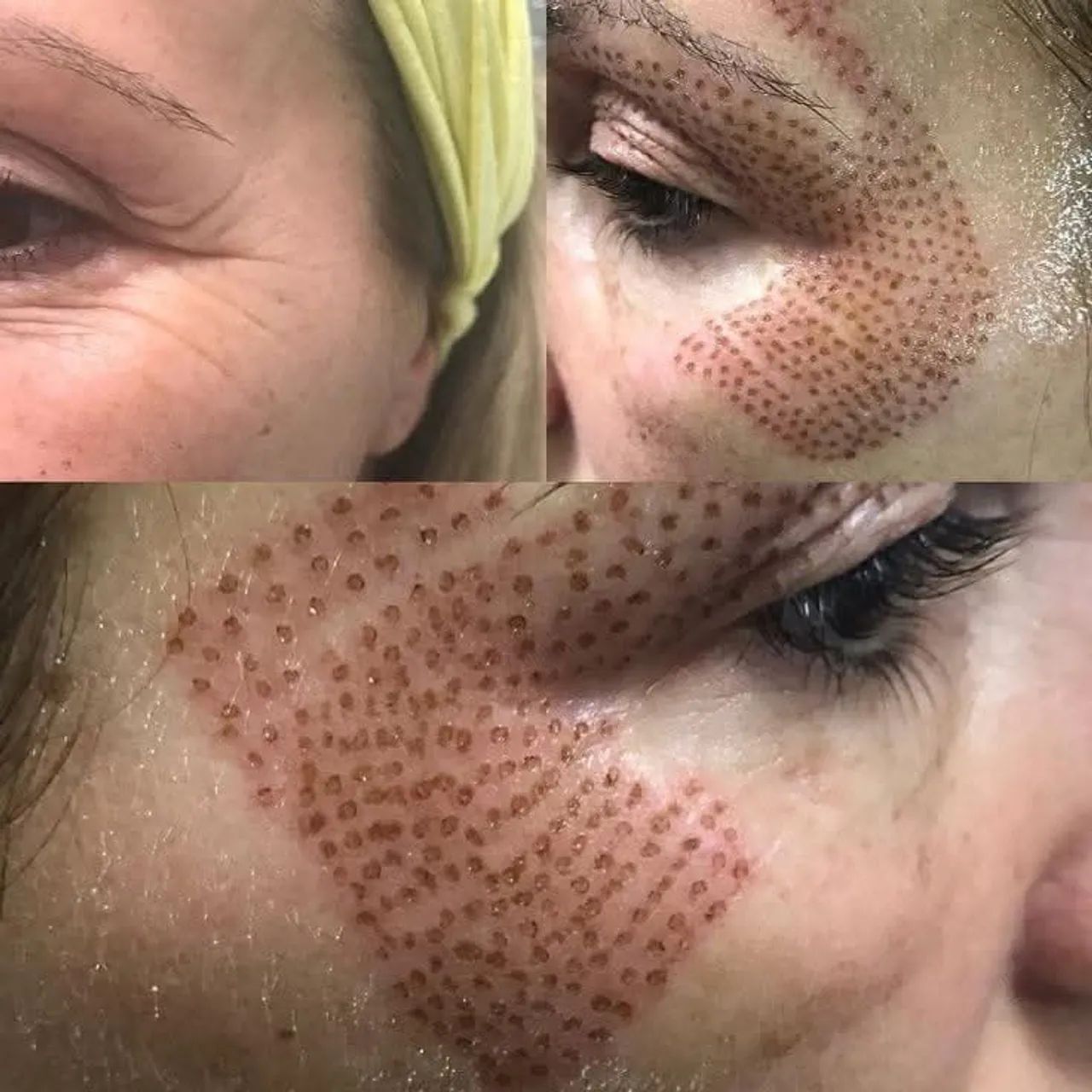 Blefaroplastia Modelos  - Foto 2