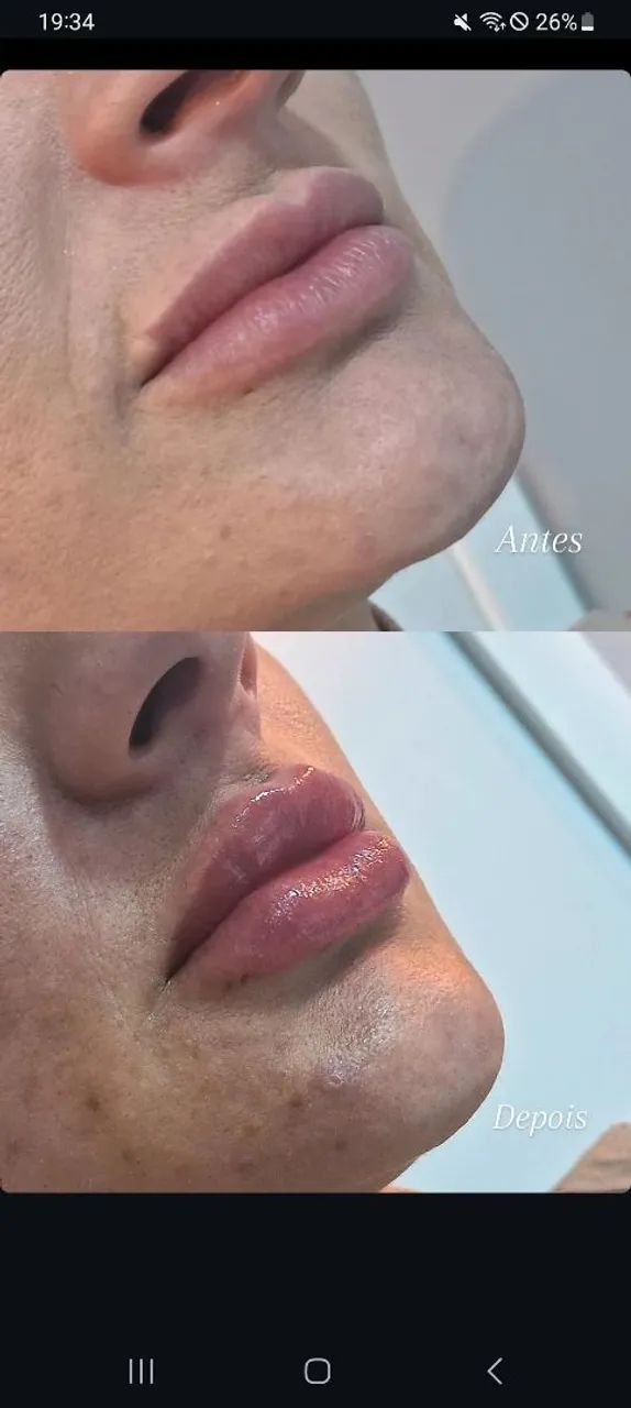 Preenchimentos Faciais, corporais e íntimo - Foto 2