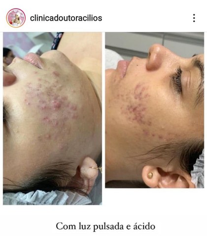 Protocolo para Acne - Foto 2