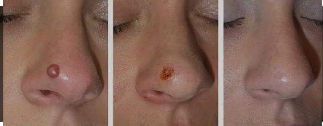 Limpeza de pele bem profunda/ retire sinais e verrugas  - Foto 3