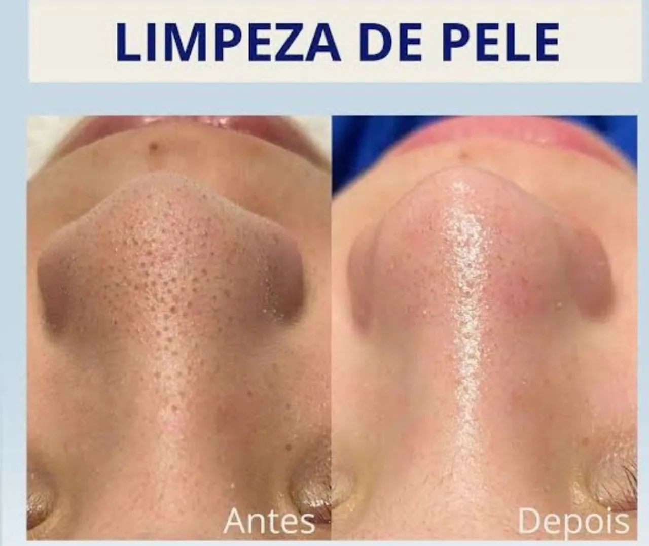 Limpeza de pele bem profunda/ retire sinais e verrugas 