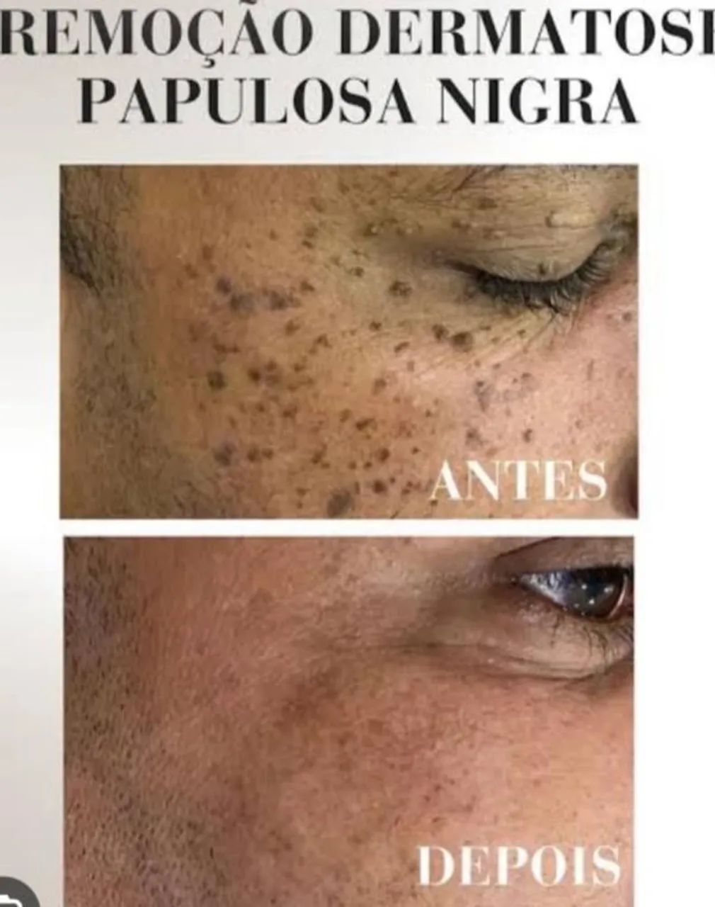 Retirada retirada de sinais - Foto 4