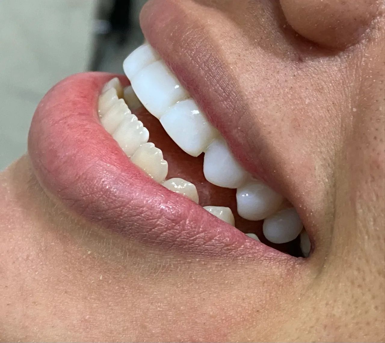 Facetas em Resina - Foto 2