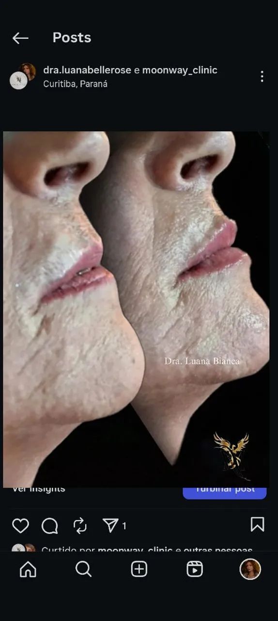 Preenchimentos Faciais, corporais e íntimo - Foto 3