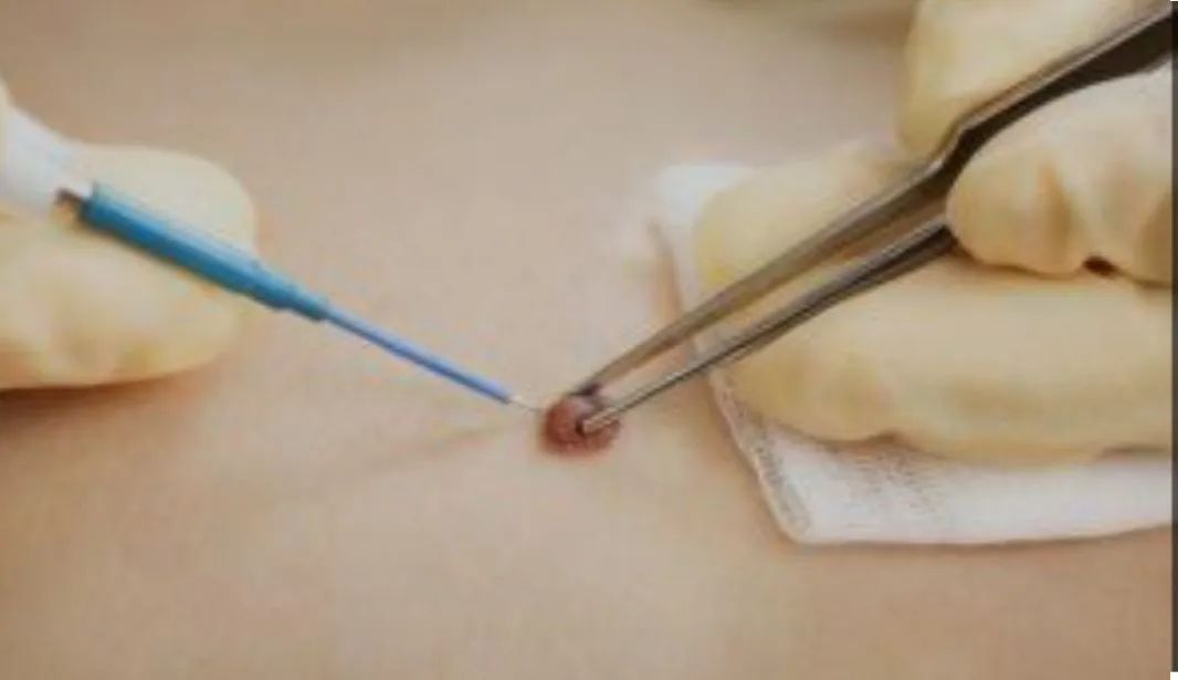 Limpeza de pele bem profunda/ retire sinais e verrugas  - Foto 2